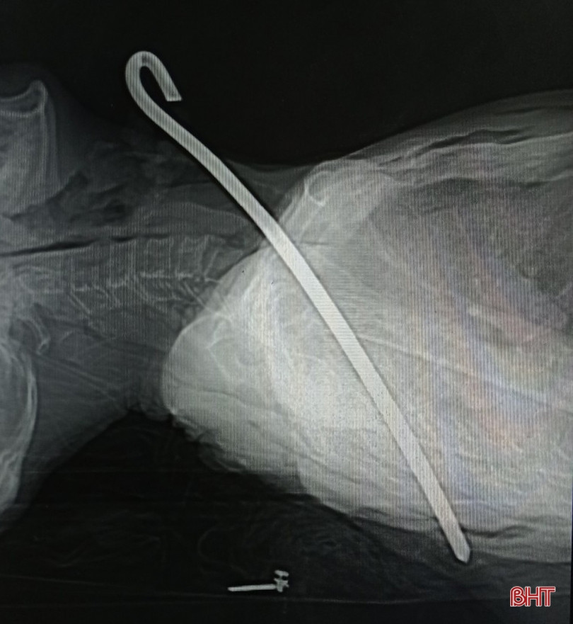 Hà Tĩnh: Cứu sống cụ ông bị khúc sắt dài 30cm đâm thấu cổ