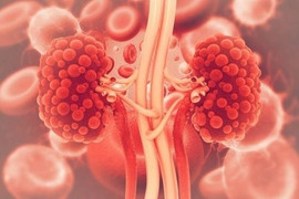 Những biến chứng của bệnh sỏi thận 