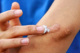 Bộ Y tế đình chỉ, thu hồi toàn quốc, yêu cầu tiêu hủy 1 loại gel 'ngừa sẹo' do vi phạm 3 lỗi
