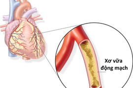 Cảnh báo nguy cơ nhồi máu cơ tim dịp lễ, Tết gia tăng