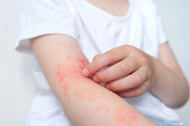 Điều trị viêm da dị ứng thế nào cho hiệu quả?