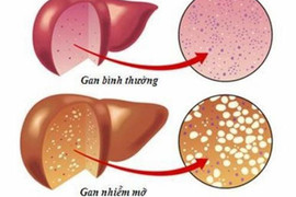 Hiểu đúng về gan nhiễm mỡ