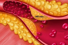 Mỡ máu cao không được chủ quan, kể cả người gầy
