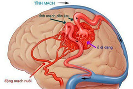 Đột quỵ thầm lặng