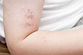 Những điều cần biết về bệnh zona thần kinh