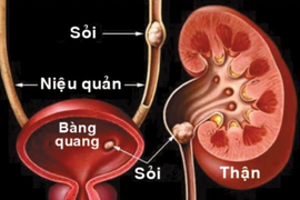 "Sỏi im lặng" âm thầm gây biến chứng nặng