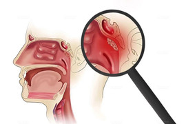 Biểu hiện cảnh báo ung thư vòm họng giai đoạn đầu