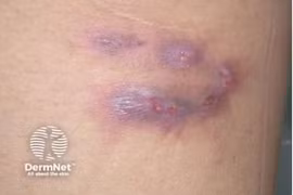 Thái Lan ban hành cảnh báo khẩn cấp về bệnh "sốt đất"