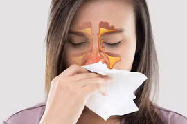 Phòng ngừa viêm mũi xoang do nấm xâm nhập