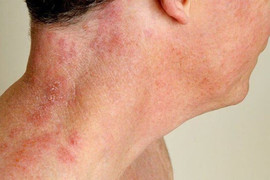 Vì sao người lớn tuổi dễ mắc bệnh zona thần kinh?