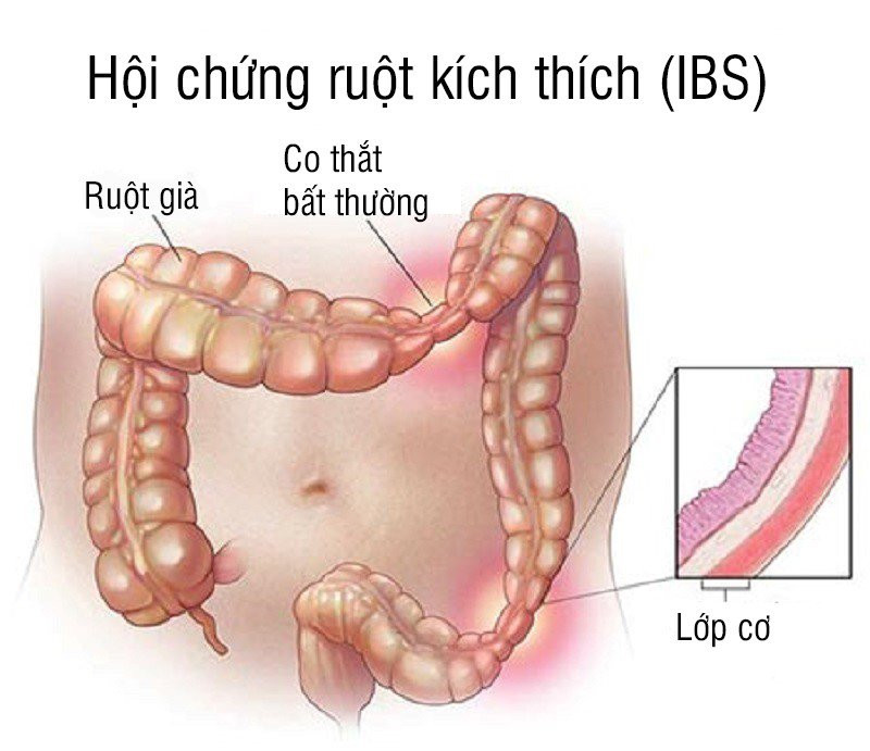 Tìm hiểu về hội chứng ruột kích thích - Ảnh 1. Tìm hiểu hội chứng ruột kích thích - nỗi phiền toái khó nói của nhiều người