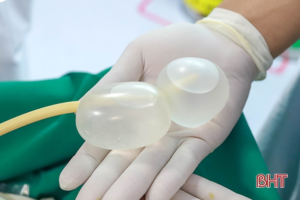 Bệnh viện đầu tiên ở Hà Tĩnh triển khai phương pháp khởi phát chuyển dạ bằng bóng đôi giúp hạn chế sinh mổ