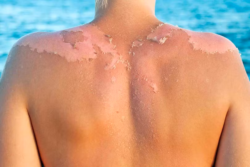 Chị em cần làm gì để tránh tác hại của ánh nắng mặt trời khi hè về?