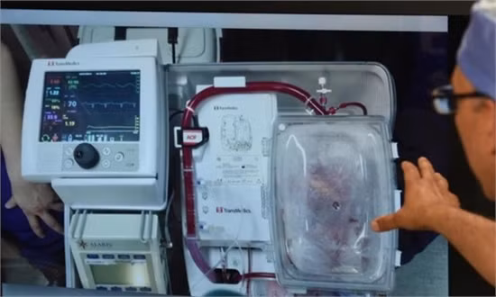 Cấy ghép thành công tim không còn đập ảnh 1