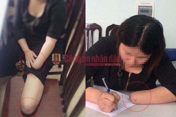 vu thue chat chan tay chi la 1 trong 8 000 vu truc loi bao hiem moi nam