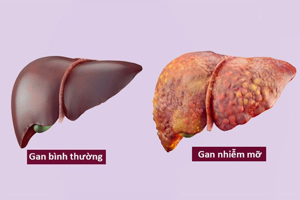Phòng gan nhiễm mỡ, cách gì?