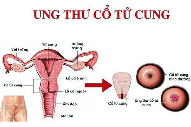 Cẩn trọng với các dấu hiệu ung thư cổ tử cung