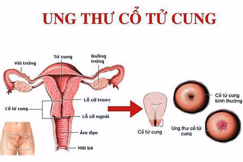 Cẩn trọng với các dấu hiệu ung thư cổ tử cung