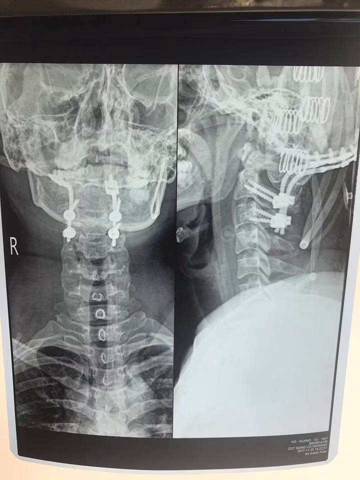 hy huu cuu song benh nhan bi trat dot song co hiem gap