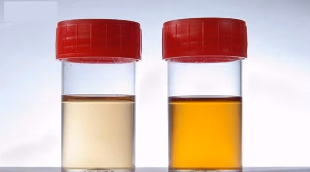 Chỉ với 3 giây, bạn có thể kiểm tra mình có đang bị mất nước hay không