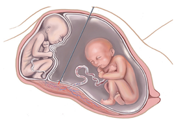 Nội soi buồng ối điều trị hội chứng truyền máu song thai bằng laser: Can thiệp đúng nguyên nhân, trao sự sống cho hai thai nhi