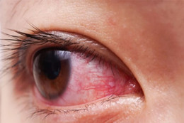 Các bệnh mắt phổ biến ở người Việt: Thống kê và lời khuyên từ chuyên gia