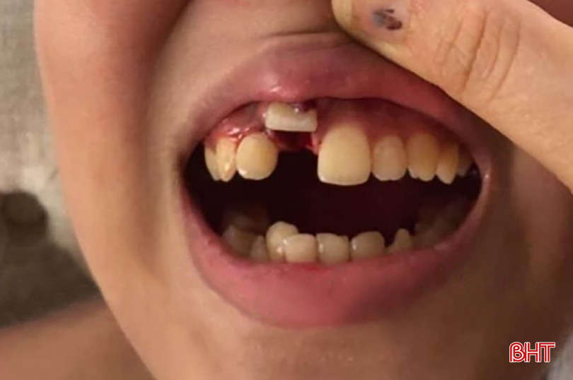 Chấn thương răng khiến răng bị cắm lệch vào vị trí khác. Bài 1 - răng cắm nhầm.jpg
