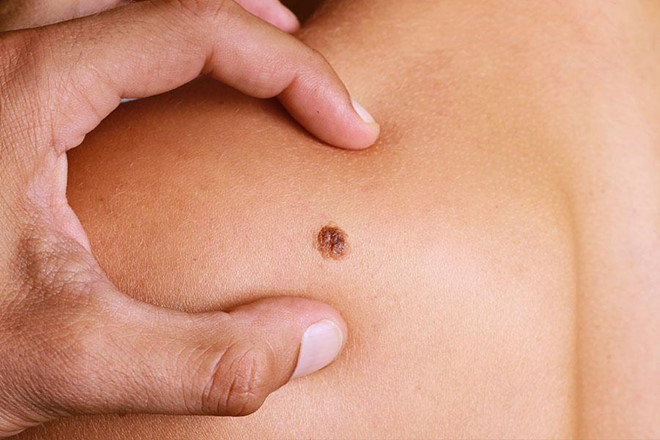 Ung thư da: Đây là dạng ung thư phổ biến nhất trên thế giới. Hơn một triệu người được chẩn đoán mắc bệnh ung thư da mỗi năm. Nếu được phát hiện sớm, ung thư da có thể điều trị dễ dàng. Ung thư da phổ biến hơn ở những người người thường xuyên đi dưới ánh nắng mặt trời hoặc bị cháy nắng. Ảnh: Lifespan. 9 vấn đề sức khỏe có thể xảy ra khi nắng nóng 40 độ C