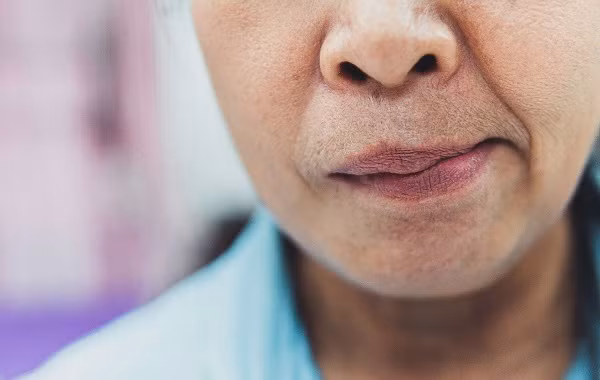 Chữa liệt mặt mùa lạnh cần chú ý những điều này