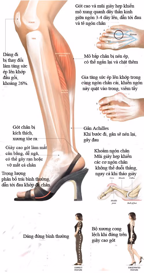 Cảnh báo nguy cơ do giày cao gót chị em nên tránh