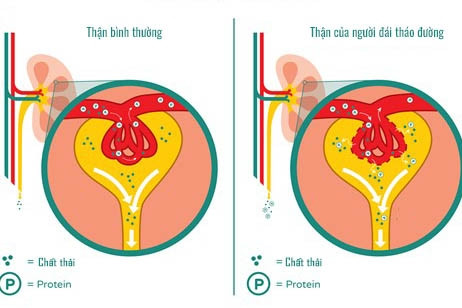 Đường máu cao ảnh hưởng thế nào đến thận?