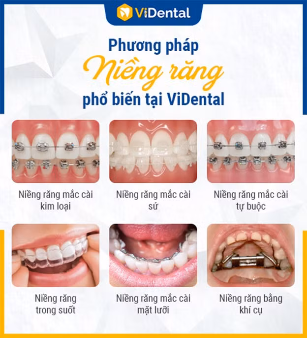 Niềng răng rút ngắn thời gian, không đau, không cần nhổ răng tại ViDental