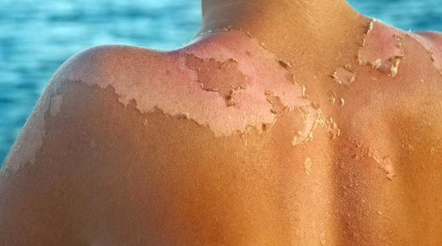 Cách xử trí da cháy nắng phục hồi nhanh