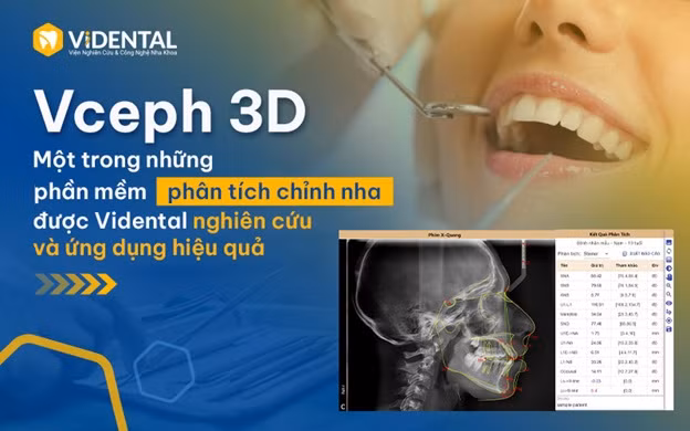 Niềng răng rút ngắn thời gian, không đau, không cần nhổ răng tại ViDental