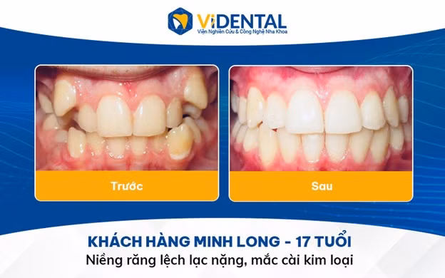 Niềng răng rút ngắn thời gian, không đau, không cần nhổ răng tại ViDental