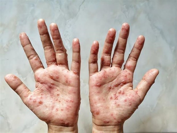 WHO ban bố tình trạng khẩn cấp y tế toàn cầu đối với bệnh đậu mùa khỉ hình ảnh 1 WHO ban bố tình trạng khẩn cấp y tế toàn cầu đối với bệnh đậu mùa khỉ