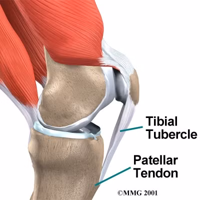 Viêm gân bánh chè.