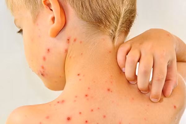 7 quan niệm sai lầm về sốt xuất huyết khiến bệnh dễ trở nặng