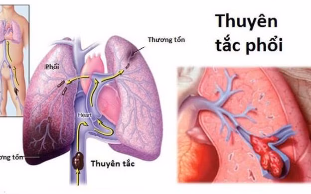 Biến chứng ít biết của các cục máu đông