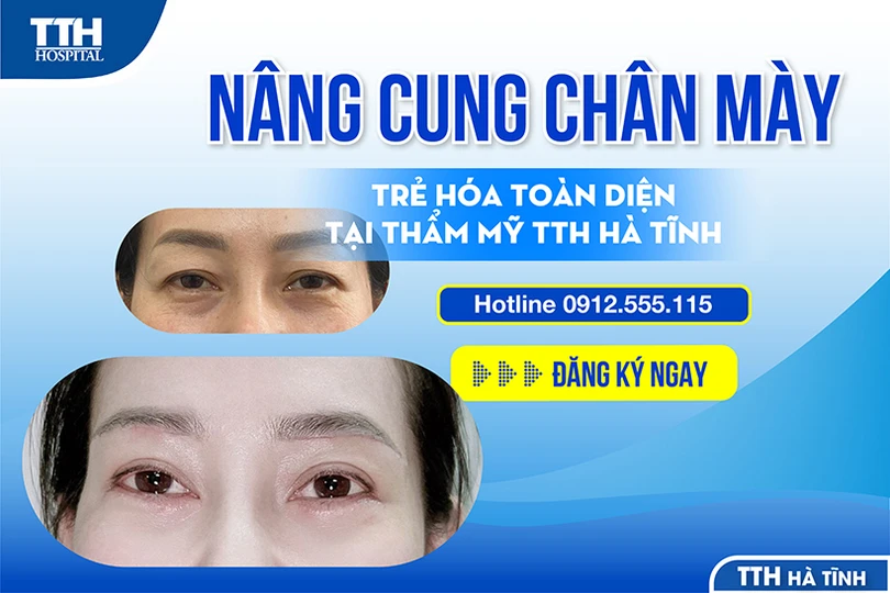 Nâng cung chân mày, trẻ hoá đôi mắt tại thẩm mỹ TTH Hà Tĩnh