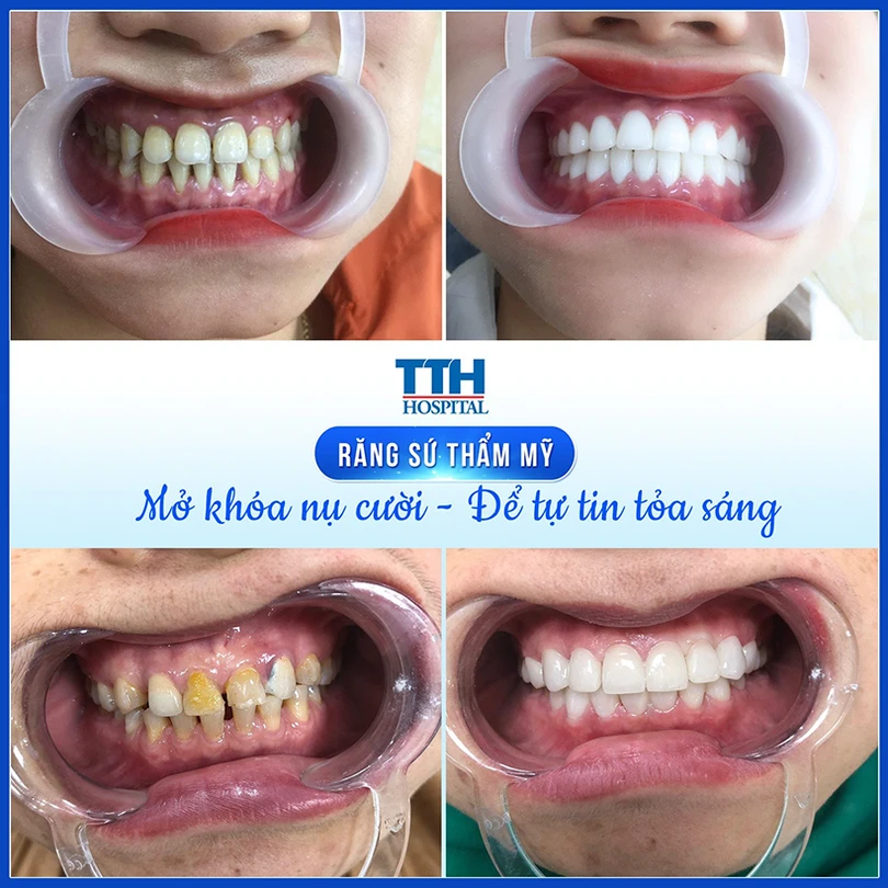 Bọc răng sứ an toàn, trắng sáng, thẩm mỹ, độ bền cao tại TTH Hà Tĩnh