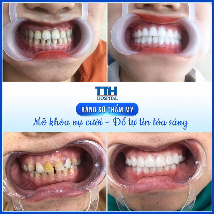 Bọc răng sứ an toàn, trắng sáng, thẩm mỹ, độ bền cao tại TTH Hà Tĩnh