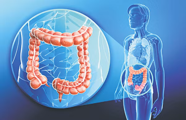 phat hien som ung thu dai trang