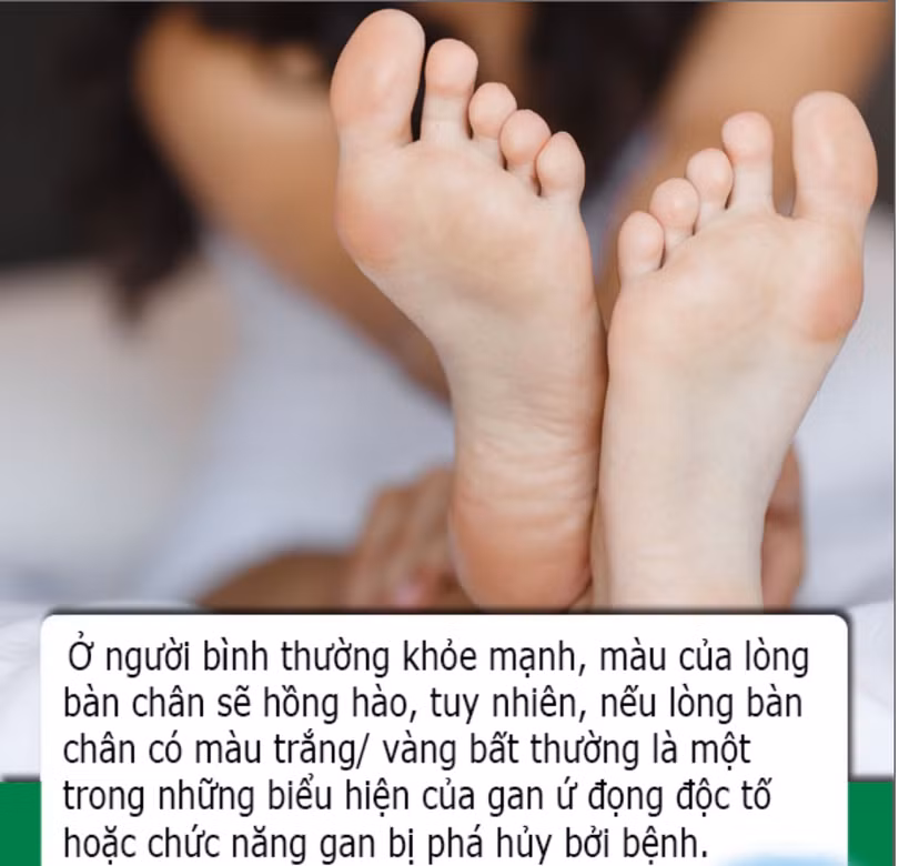Bàn chân có 4 dấu hiệu này cho biết sức khỏe lá gan của bạn đang suy giảm