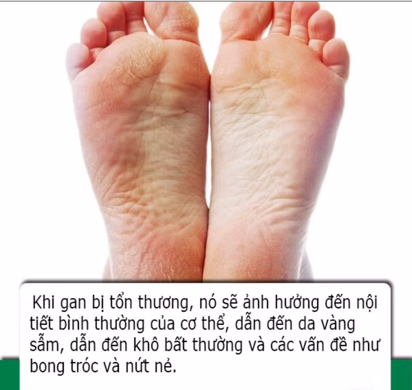 Bàn chân có 4 dấu hiệu này cho biết sức khỏe lá gan của bạn đang suy giảm