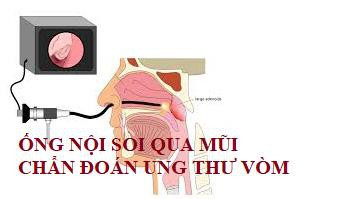 phát hiện sớm ung thư vòm mũi họng hình 3 Phát hiện sớm ung thư vòm mũi họng
