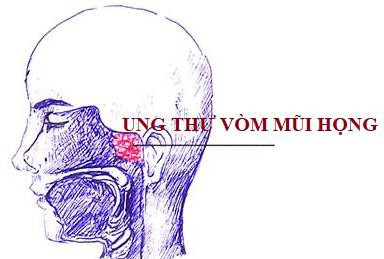 phát hiện sớm ung thư vòm mũi họng hình 2 Phát hiện sớm ung thư vòm mũi họng