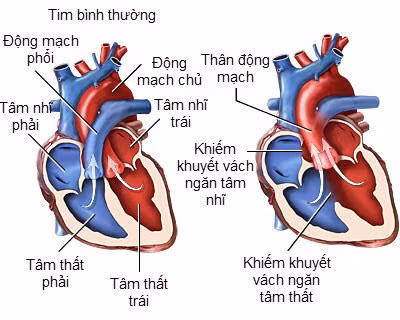 COVID-19 thể nặng đe dọa người mắc bệnh tim bẩm sinh ra sao?