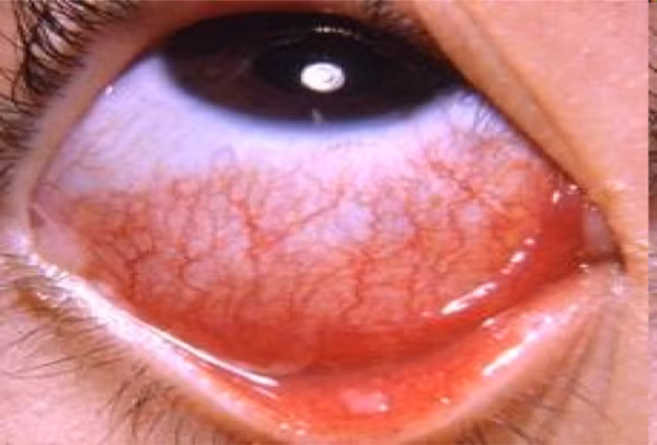 Chuyển mùa, coi chừng viêm kết mạc cấp