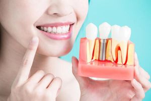 Nên cấy răng Implant hay làm bắc cầu răng sứ?